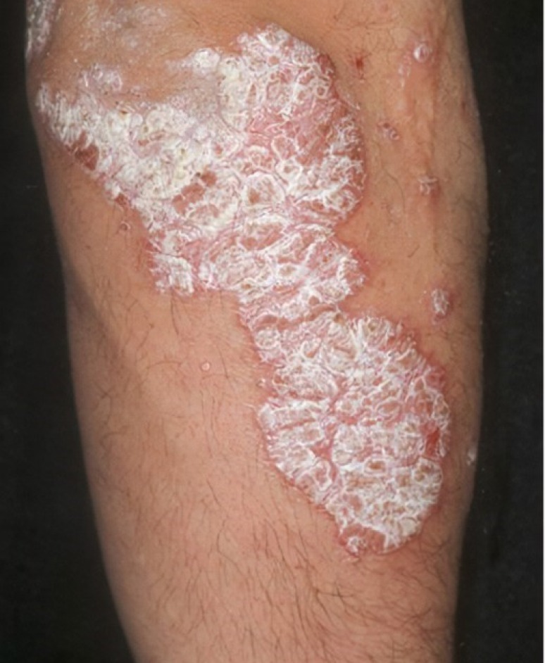 Psoriasis plaques on legs before UVB light therapy