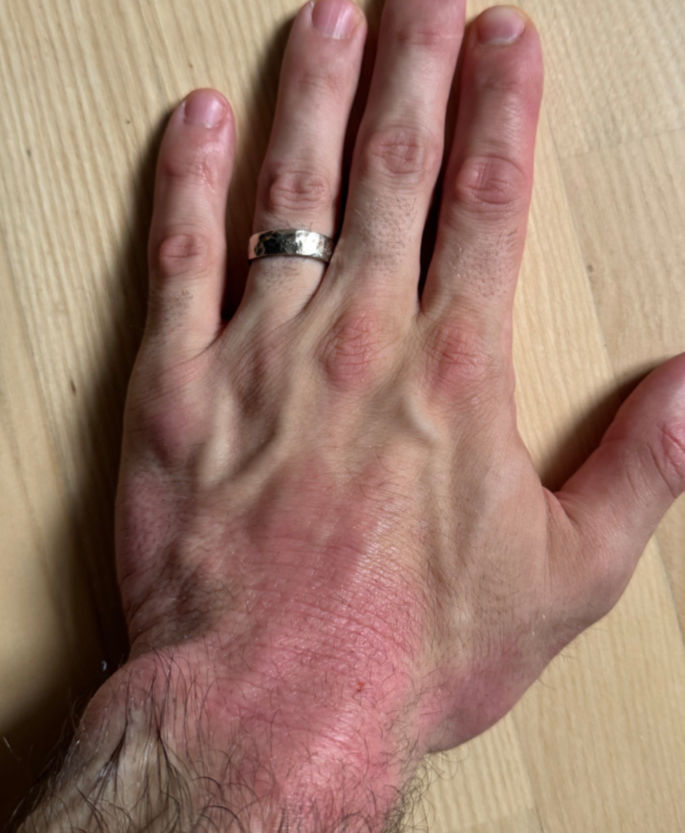 Ezcema flare before ultraviolet light treatment at home