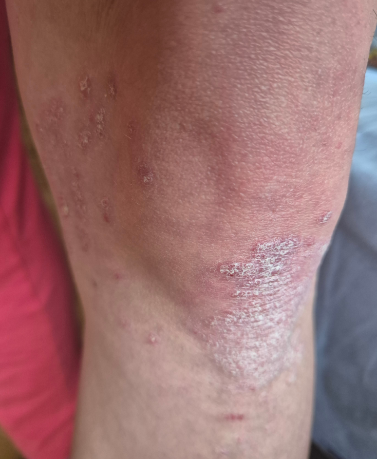 Stubborn psoriasis on knees before light therapy