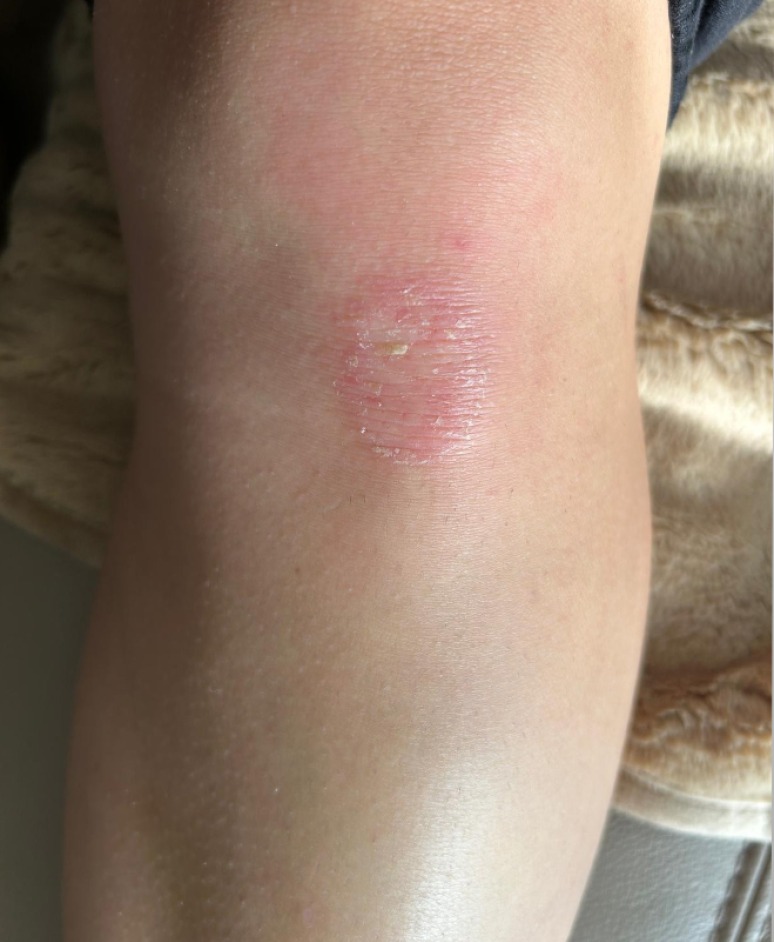 Psoriasis before narrowband UVB treatment