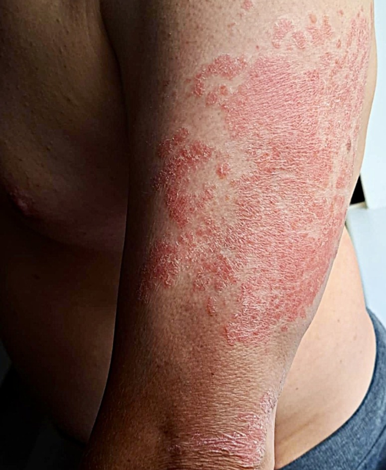 Stubborn psoriasis that cannot be controlled with topical treatment