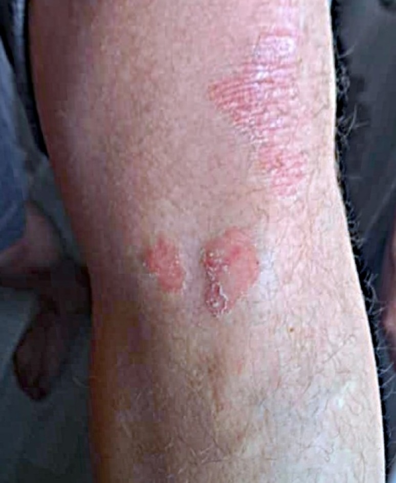 Psoriasis on knees before patient started UV Tactus phototherapy treatment at home